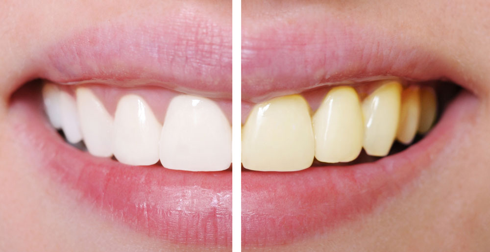 TeethWhitening