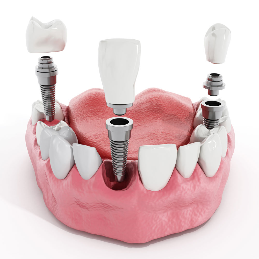 dental-implants